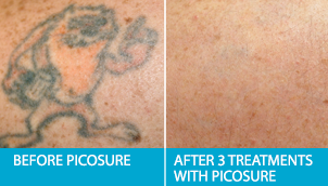 JHow Does Laser Tattoo Removal Work? Before After Pics