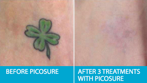 Edmonton Laser Tattoo Removal Before After Pictures