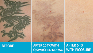 Laser Tattoo Removal Edmonton Picosure Treatments After 6 Sessions