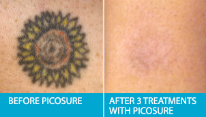 Post Treatment Tattoo Removal WIth Laser. Picosure Edmonton Laser Clinic.