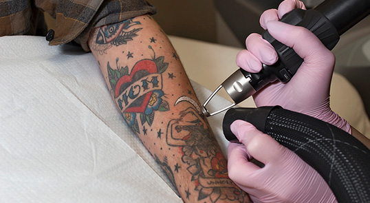 Tattoo Removal EdmontonLaser Clinic Sherwood Park Urban Laser