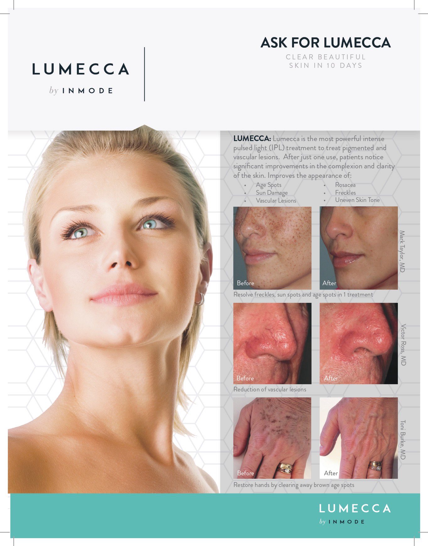 before and after lumecca. lumecca treatments edmonton. facial treatments for spot removal. freckle reduction.
