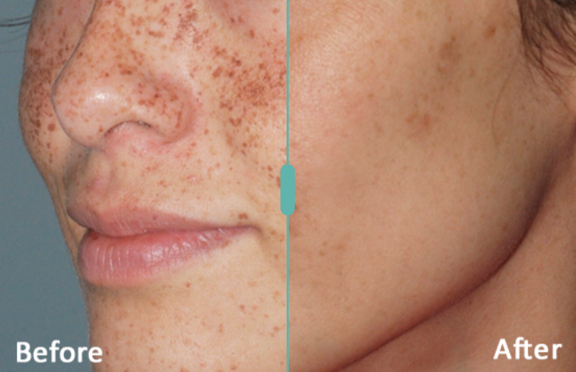 lumecca facial treatments before and after. edmonton facial spots laser removal.